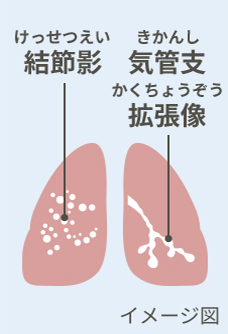 結節影(けっせつえい)と気管支拡張型像(きかんしかくちょうぞう)イメージ図