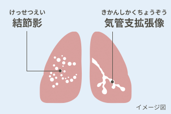 結節影(けっせつえい)と気管支拡張型像(きかんしかくちょうぞう)イメージ図